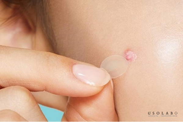 Sử dụng miếng dán mụn y khoa