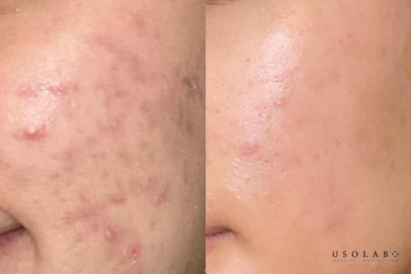Chọn sản phẩm trị mụn an toàn cần dựa theo tiêu chuẩn gì?