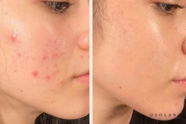 Về mặt sinh học da liễu, không có phương pháp nào có thể trị dứt điểm mụn chỉ sau 1 đêm