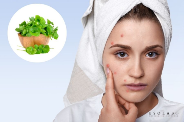 Ai nên uống rau má để cải thiện da Ai nên uống rau má để cải thiện da