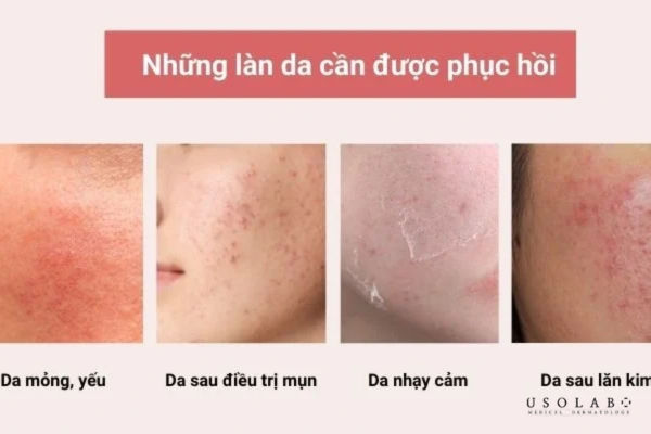 Da xỉn màu, thiếu sức sống, Da nhạy cảm, da yếu Da xỉn màu, thiếu sức sống, Da nhạy cảm, da yếu