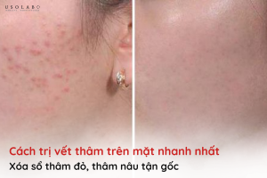 cách trị vết thâm trên mặt nhanh nhất