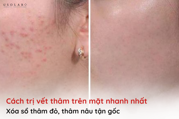 cách trị vết thâm trên mặt nhanh nhất