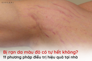 bị rạn da màu đỏ có tự hết không