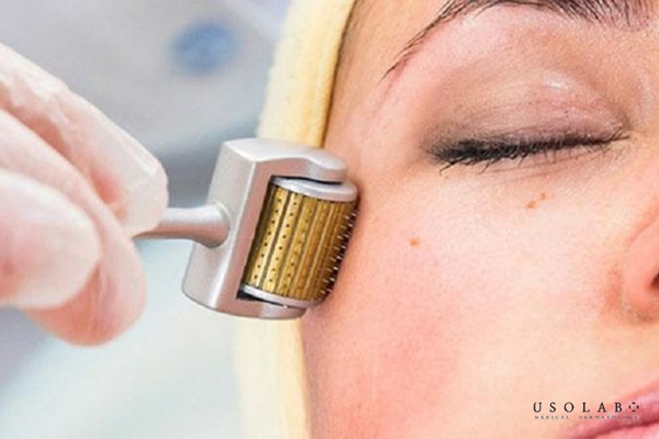 bị rạn da màu đỏ có tự hết không