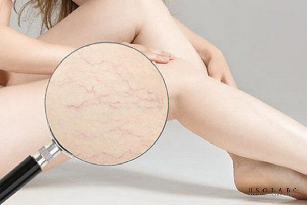 bị rạn da màu đỏ có tự hết không
