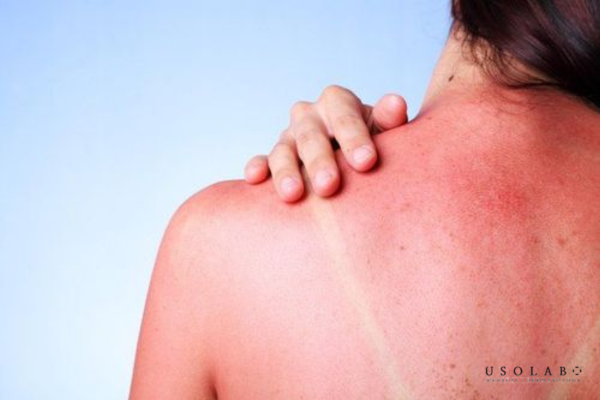 cách nhả nắng sau khi đi biển