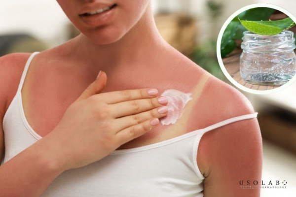 cách nhả nắng sau khi đi biển