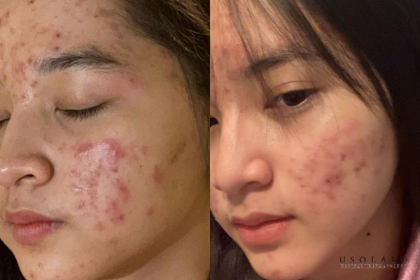 Xác định đúng loại vết thâm trước khi điều trị