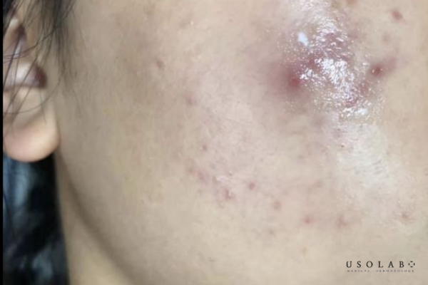 Vết thâm trên mặt kéo dài dù skincare rất kỹ