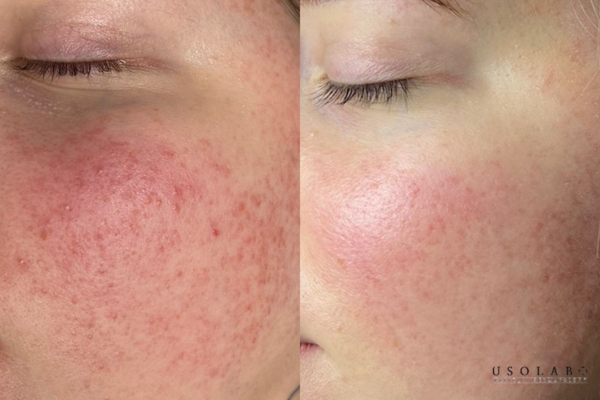 da kích ứng sau peel