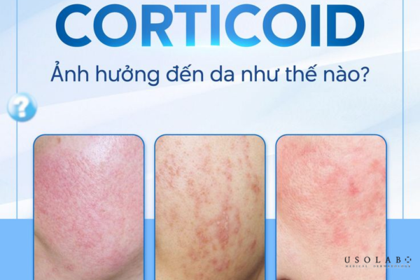 da kích ứng sau peel