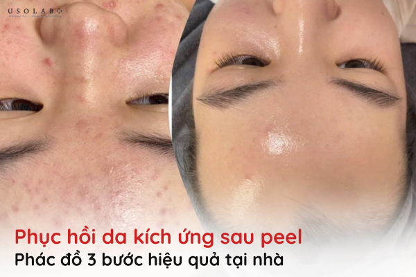da kích ứng sau peel