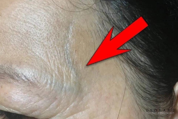 da mặt nổi gân xanh