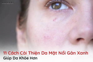 da mặt nổi gân xanh