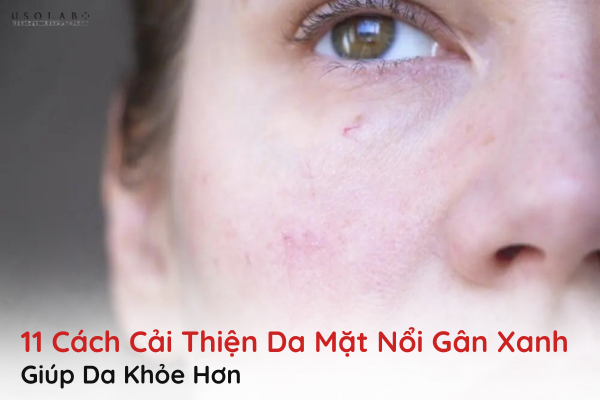 da mặt nổi gân xanh