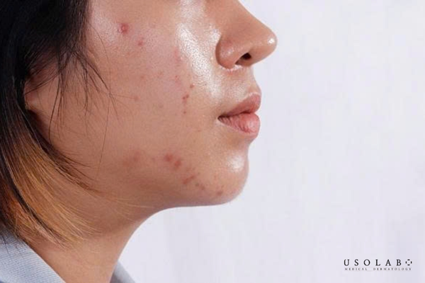 Dầu tràm là hoạt chất thiên nhiên có đặc tính kháng khuẩn và làm dịu da,