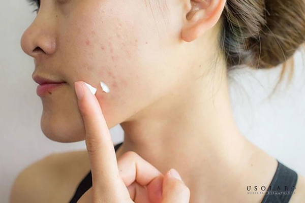 gel trị mụn