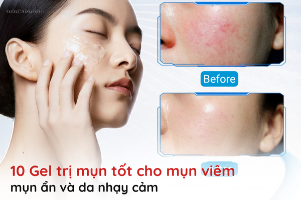 gel trị mụn