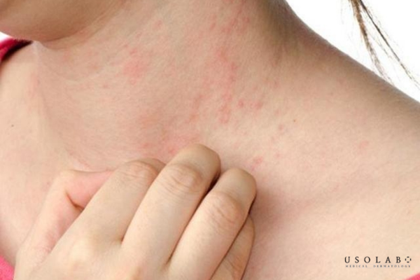 kem phục hồi da nhạy cảm