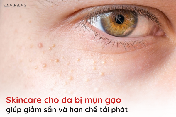 MỤN GẠO
