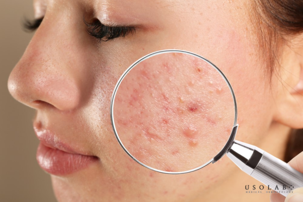 Mụn nội tiết là tình trạng mụn hình thành do sự rối loạn hoặc tăng hoạt động hormone