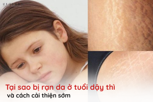 tại sao bị rạn da ở tuổi dậy thì