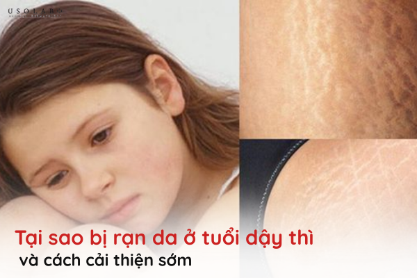 tại sao bị rạn da ở tuổi dậy thì
