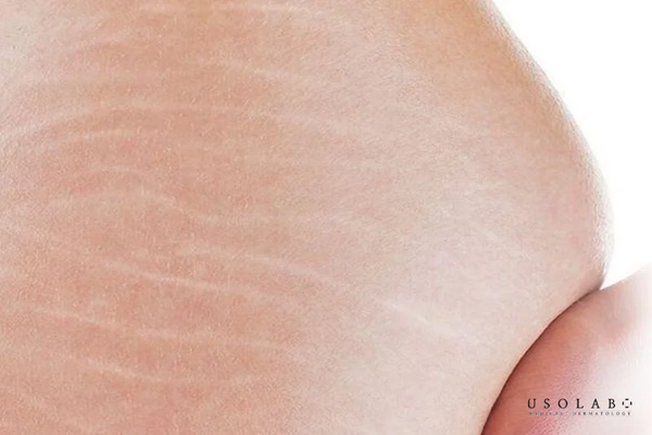 bị rạn da màu đỏ có tự hết không
