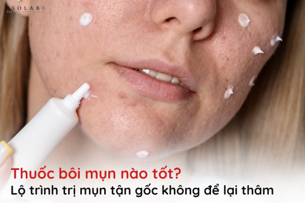thuốc bôi mụn