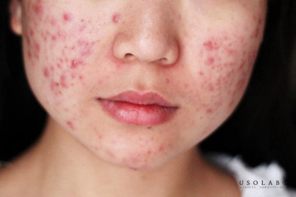 thuốc đỏ có trị mụn được không