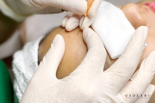 thuốc đỏ có trị mụn được không