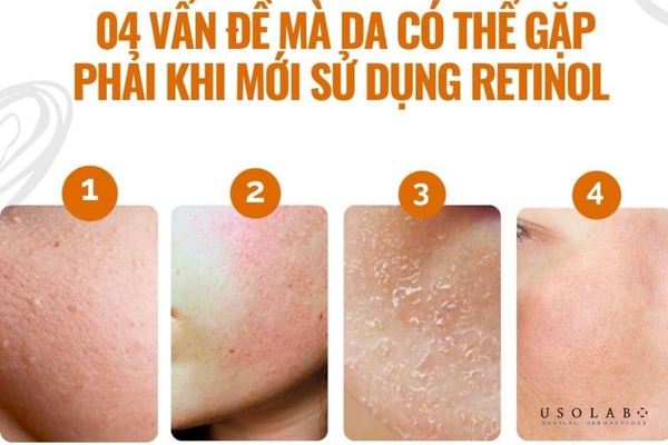 thuốc bôi mụn