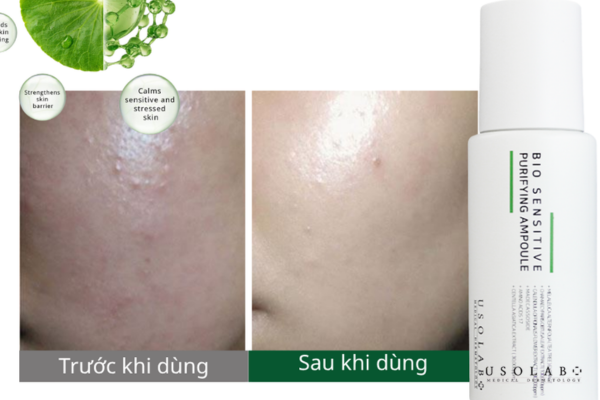 4 loại thuốc trị mụn bác sĩ khuyên dùng