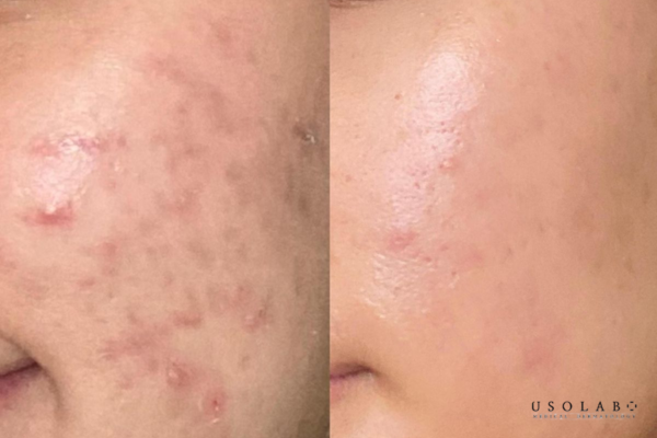 4 loại thuốc trị mụn bác sĩ khuyên dùng