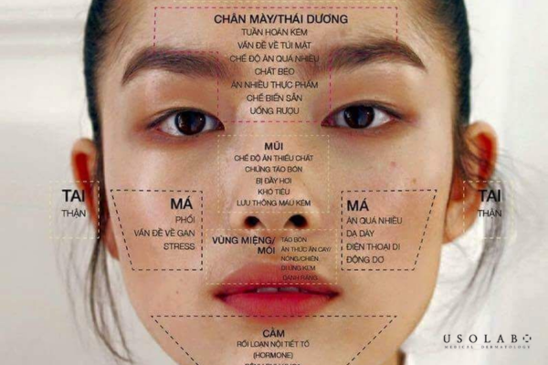 vị trí nổi mụn