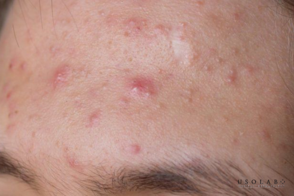 vị trí nổi mụn