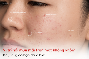 vị trí nổi mụn