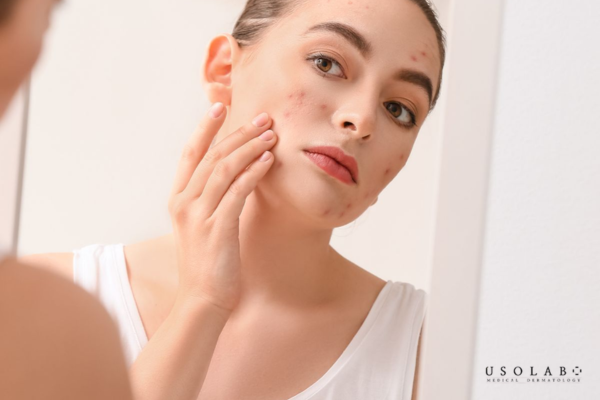 vị trí nổi mụn