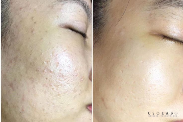 vị trí nổi mụn