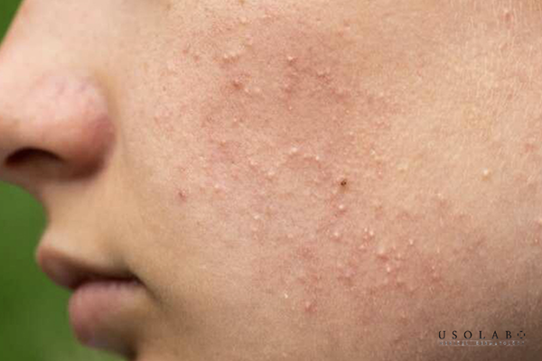 kem trị mụn ẩn