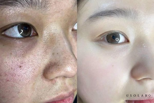 EGF tái tạo da