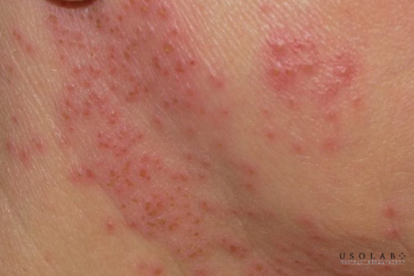 cách phục hồi da sau treatment