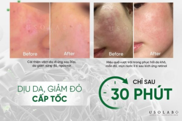 cách phục hồi da sau treatment