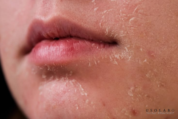 ceramide cho da treatment