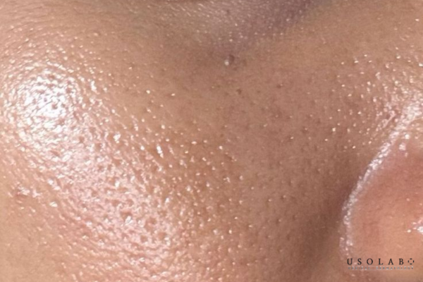 ceramide cho da treatment