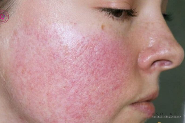 da sau treatment chăm sóc thế nào
