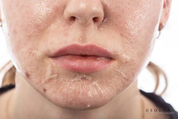 da sau treatment chăm sóc thế nào