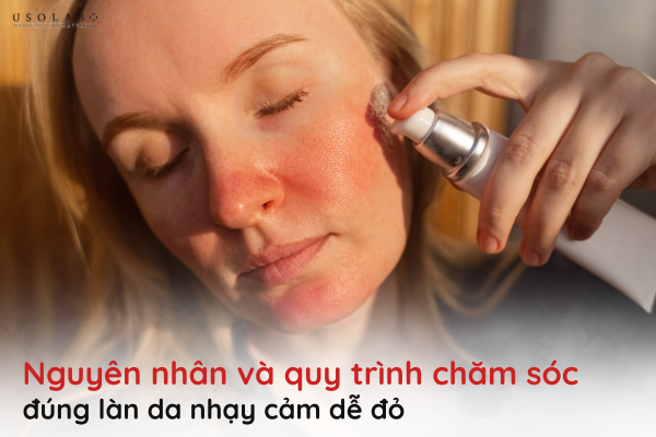 da nhạy cảm dễ đỏ
