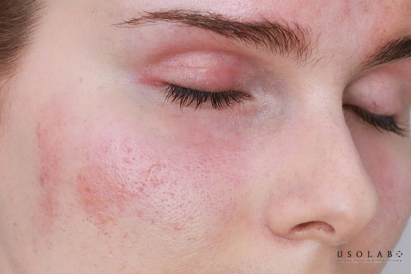 phục hồi da nóng rát sau treatment
